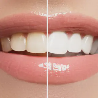 /img/30363-alternative-teeth-whitening.webp