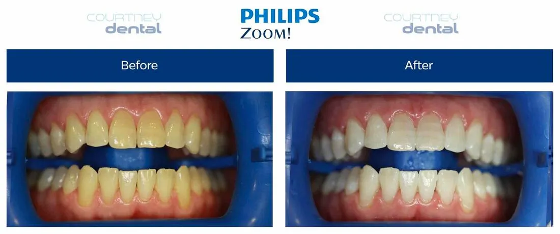 30363 teeth sensitivity after whitening