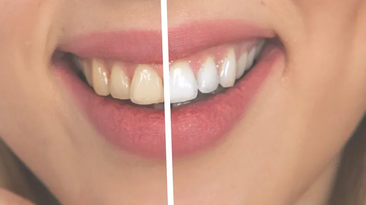/img/30365-best-teeth-whitening-nyc.webp