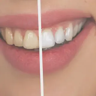 /img/30365-best-teeth-whitening-nyc.webp