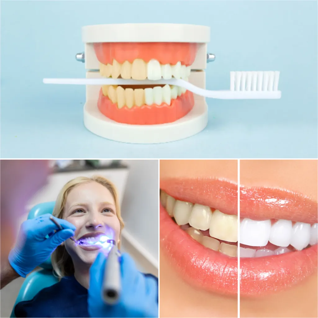 30365 in office teeth whitening