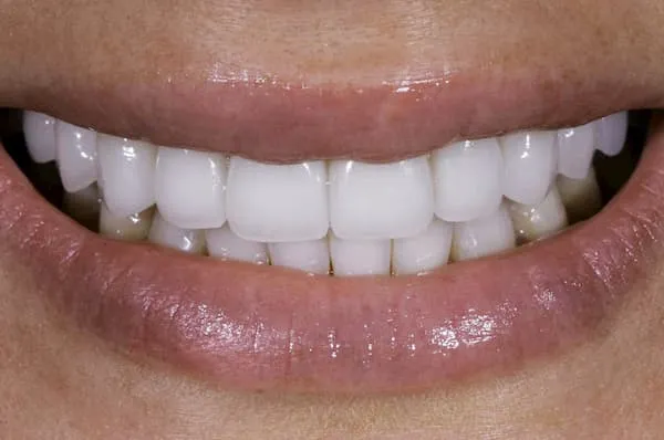 30365 teeth whitening maintenance