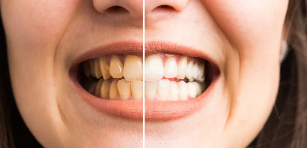 30366 teeth whitening consultation