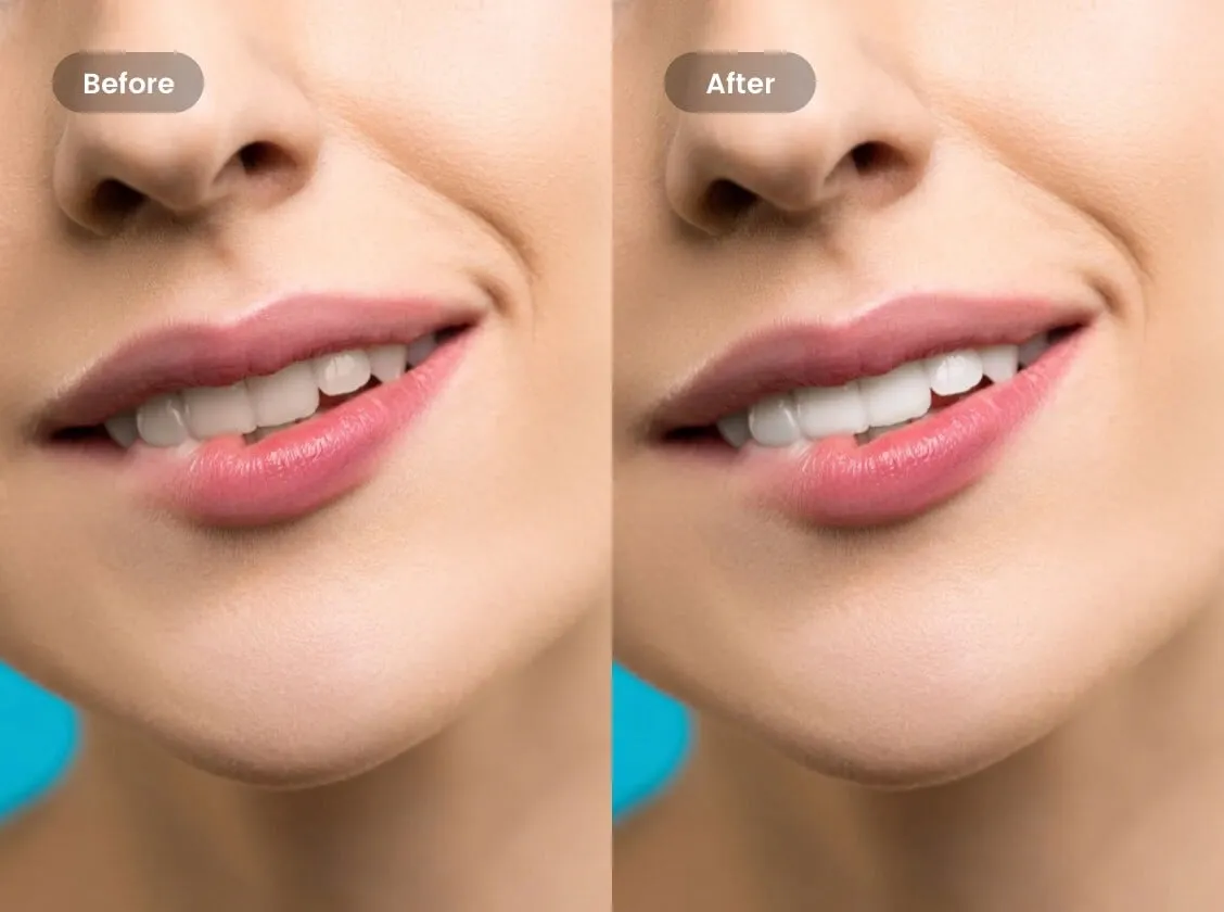 30367 before after teeth whitening